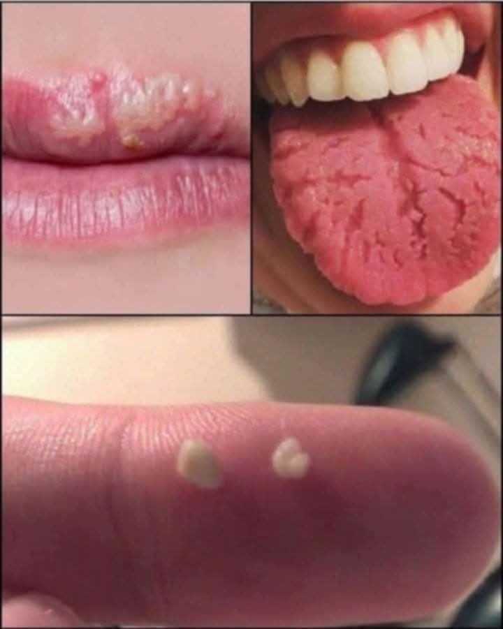 Here’s what you need to know about tonsil stones – the weird pimple-like growths in your throat